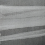 右足骨折！救急車で搬送されて、整形外科に到着、即入院。